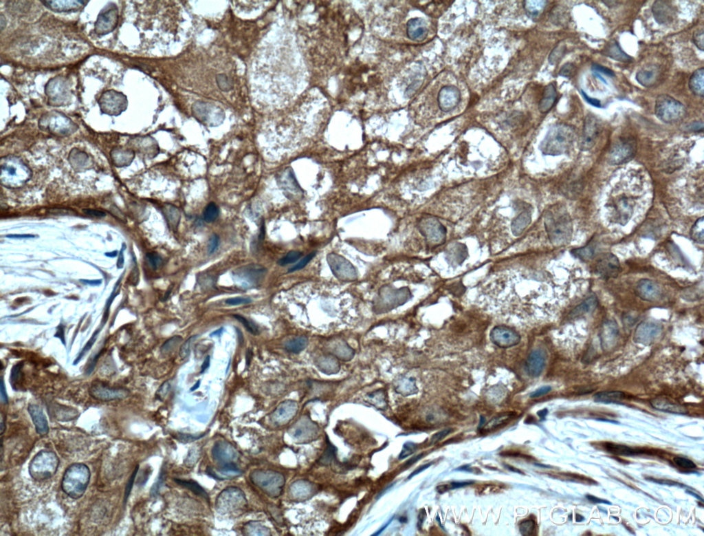 Immunohistochemistry (IHC) staining of human breast cancer tissue using PDAP1 Polyclonal antibody (15081-1-AP)