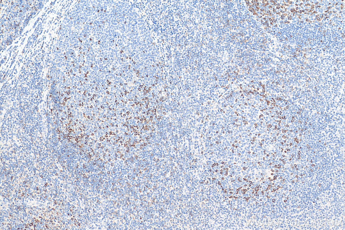 Immunohistochemistry (IHC) staining of human tonsillitis tissue using PD-1/CD279 Polyclonal antibody (18106-1-AP)