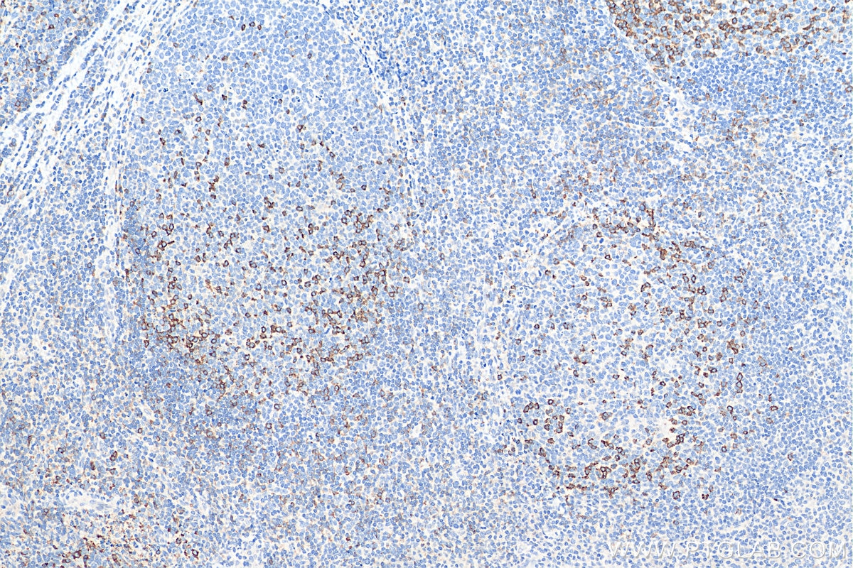 IHC staining of human tonsillitis using 18106-1-AP