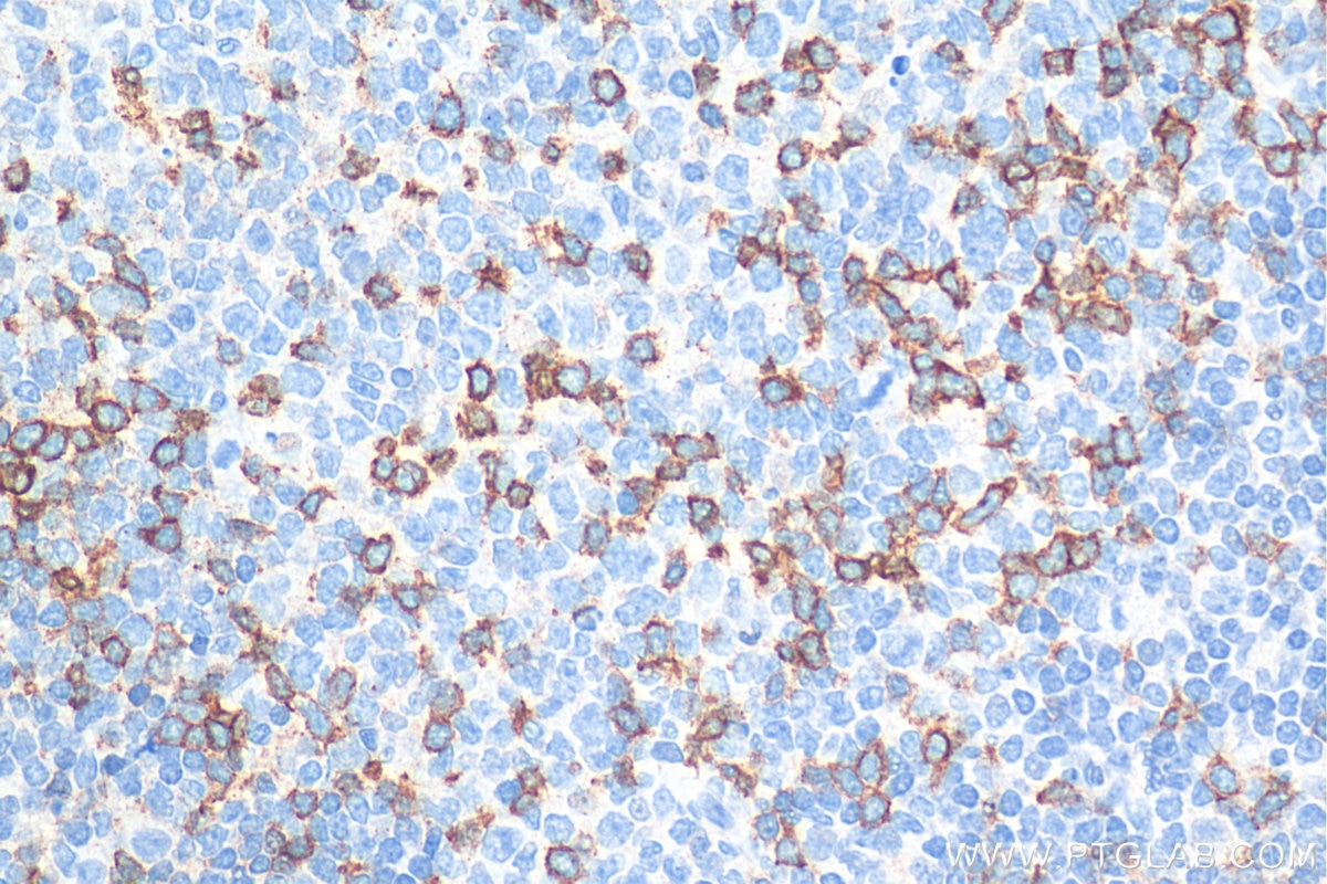 Immunohistochemistry (IHC) staining of human tonsillitis tissue using PD-1/CD279 Polyclonal antibody (18106-1-AP)
