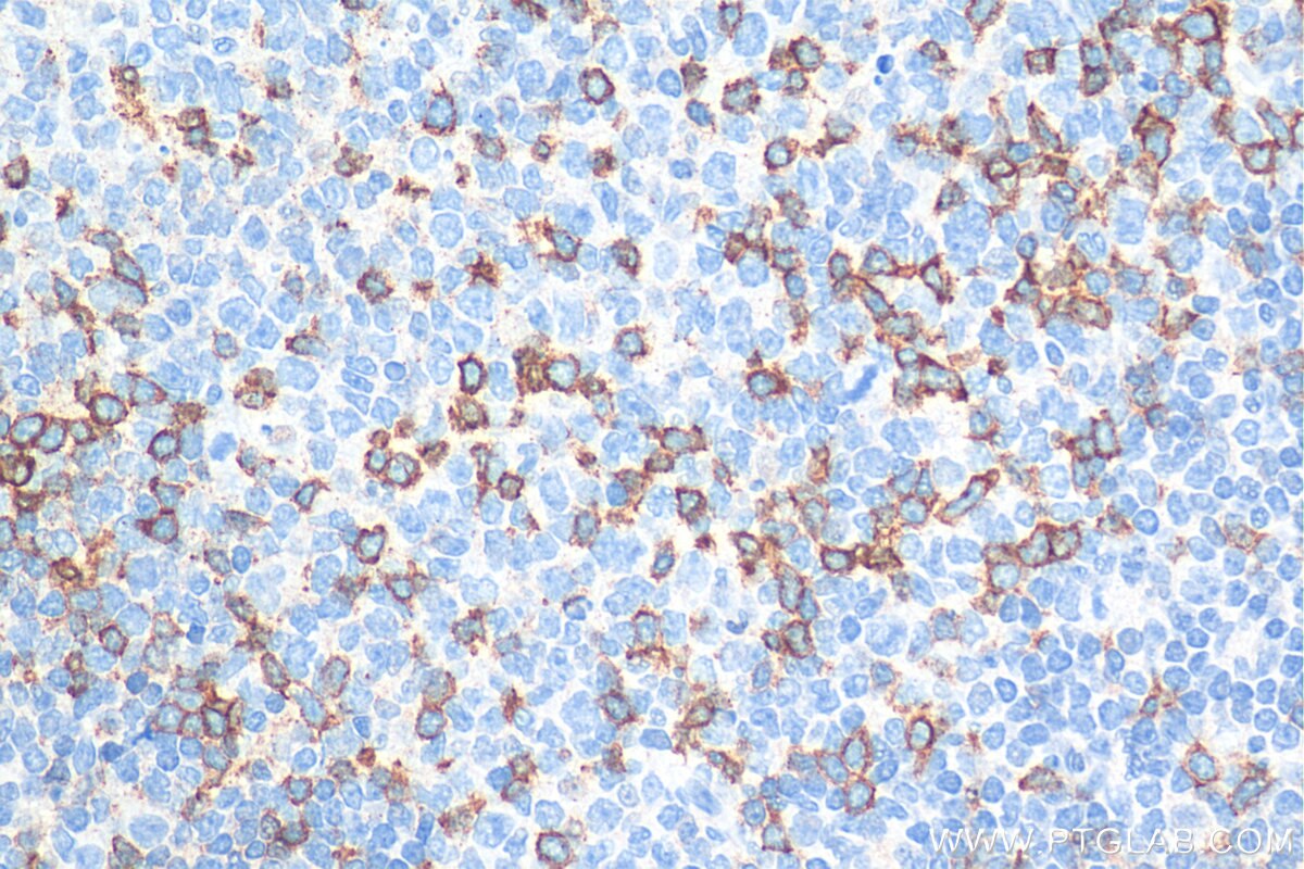 Immunohistochemistry (IHC) staining of human tonsillitis tissue using PD-1/CD279 Polyclonal antibody (18106-1-AP)