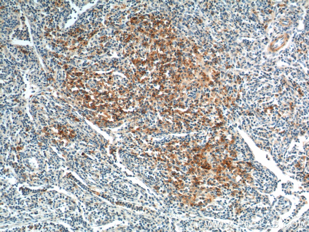 Immunohistochemistry (IHC) staining of human lymphoma tissue using PD-1/CD279 Polyclonal antibody (18106-1-AP)