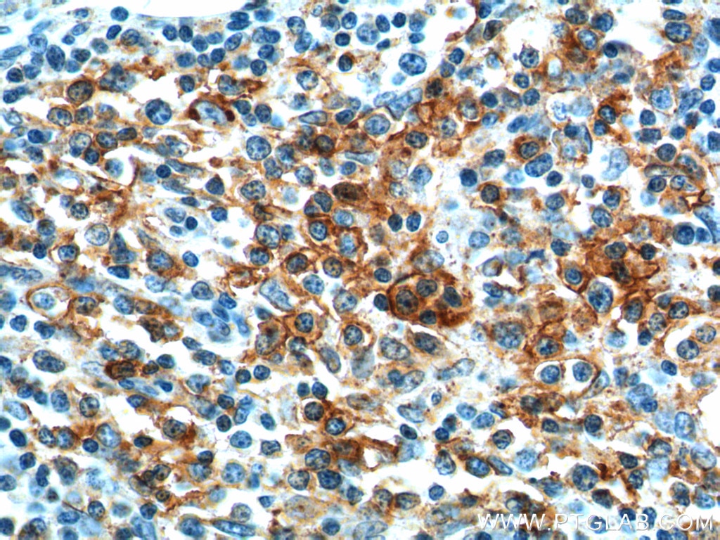 Immunohistochemistry (IHC) staining of human lymphoma tissue using PD-1/CD279 Polyclonal antibody (18106-1-AP)
