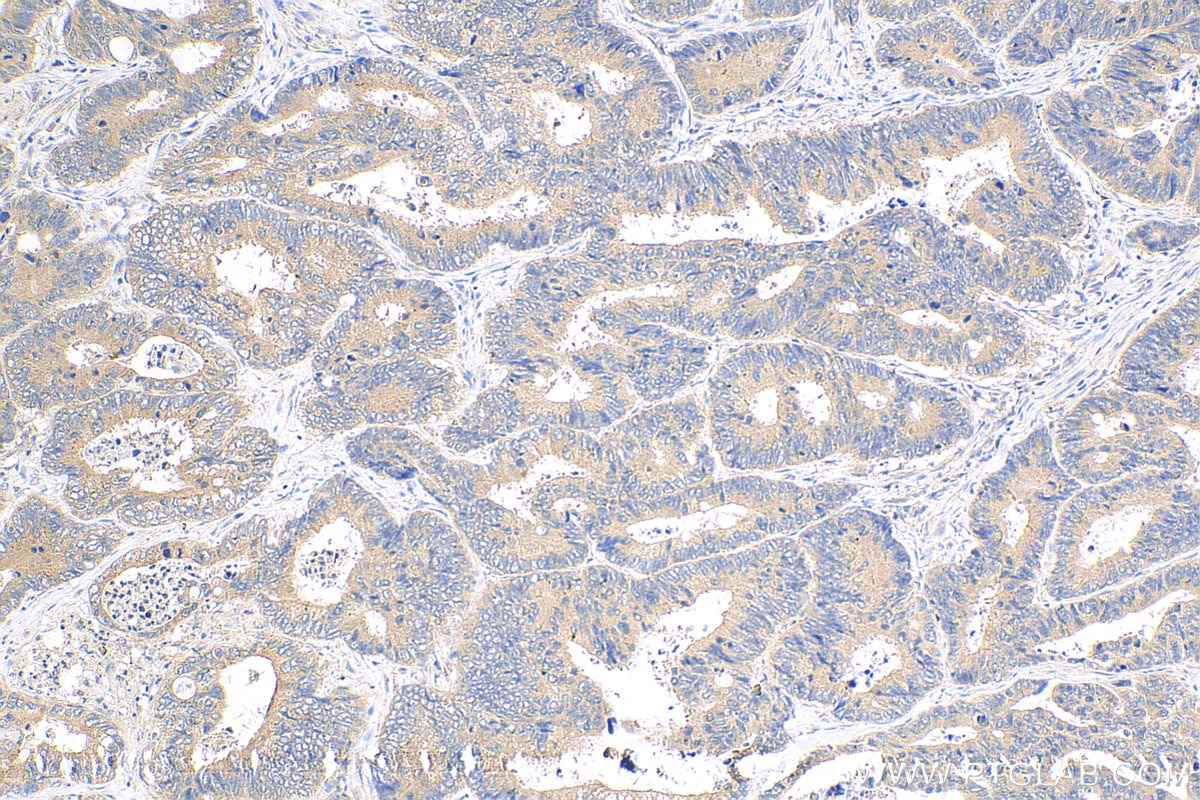 Immunohistochemistry (IHC) staining of human colon cancer tissue using CCM3/PDCD10 Polyclonal antibody (10294-2-AP)