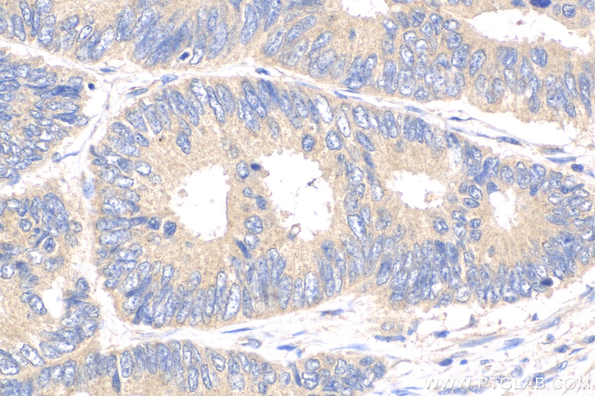 Immunohistochemistry (IHC) staining of human colon cancer tissue using CCM3/PDCD10 Polyclonal antibody (10294-2-AP)