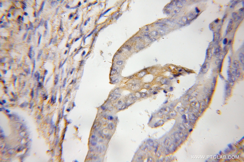 IHC staining of human colon cancer using 10294-2-AP