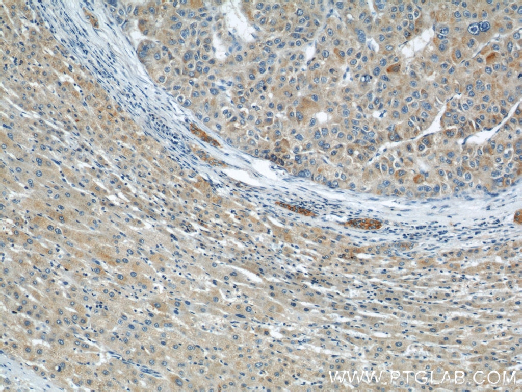 IHC staining of human liver cancer using 10294-2-AP