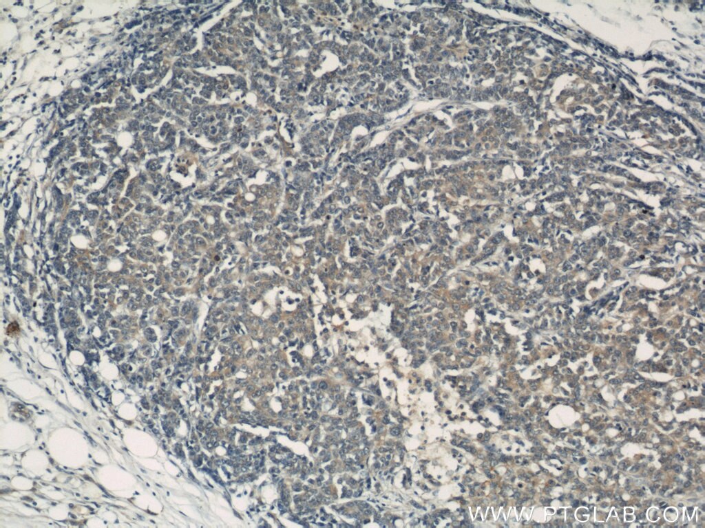 IHC staining of human colon cancer using 10294-2-AP