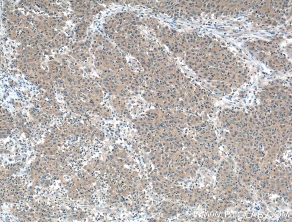 IHC staining of human colon cancer using 66440-1-Ig