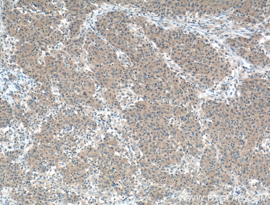 Immunohistochemistry (IHC) staining of human colon cancer tissue using CCM3/PDCD10 Monoclonal antibody (66440-1-Ig)