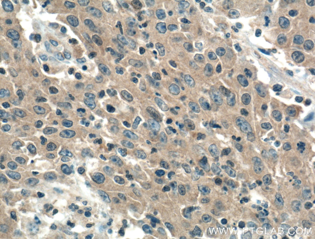Immunohistochemistry (IHC) staining of human colon cancer tissue using CCM3/PDCD10 Monoclonal antibody (66440-1-Ig)