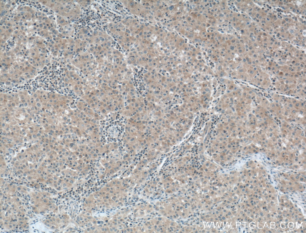 IHC staining of human liver cancer using 66440-1-Ig