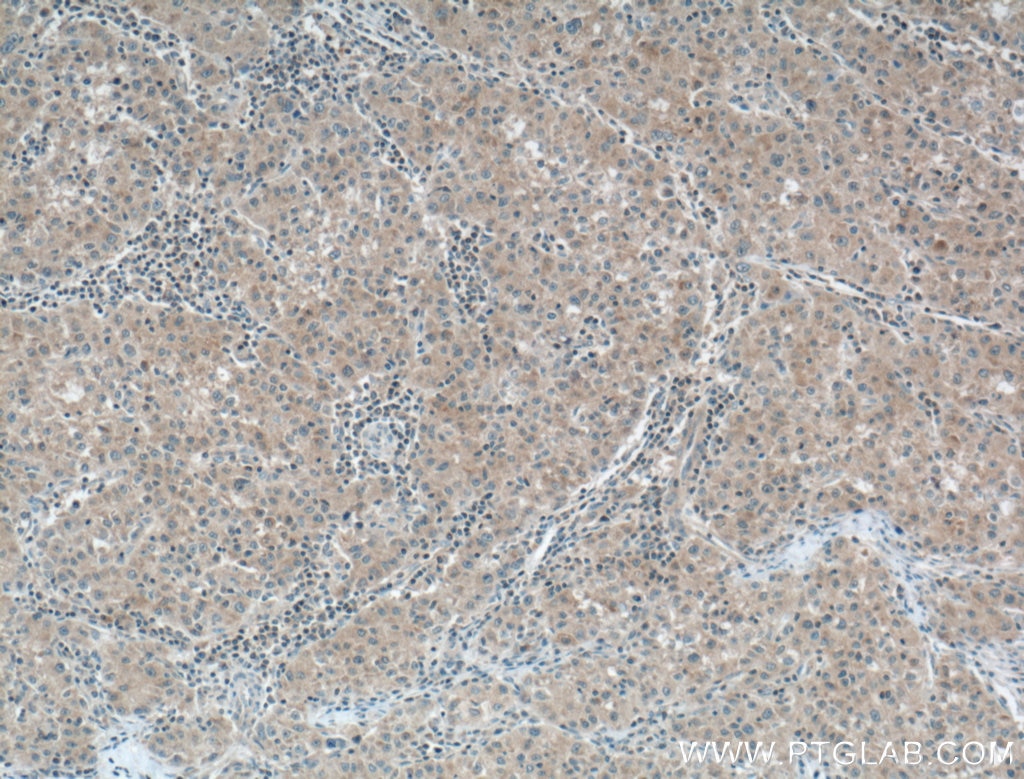 Immunohistochemistry (IHC) staining of human liver cancer tissue using CCM3/PDCD10 Monoclonal antibody (66440-1-Ig)