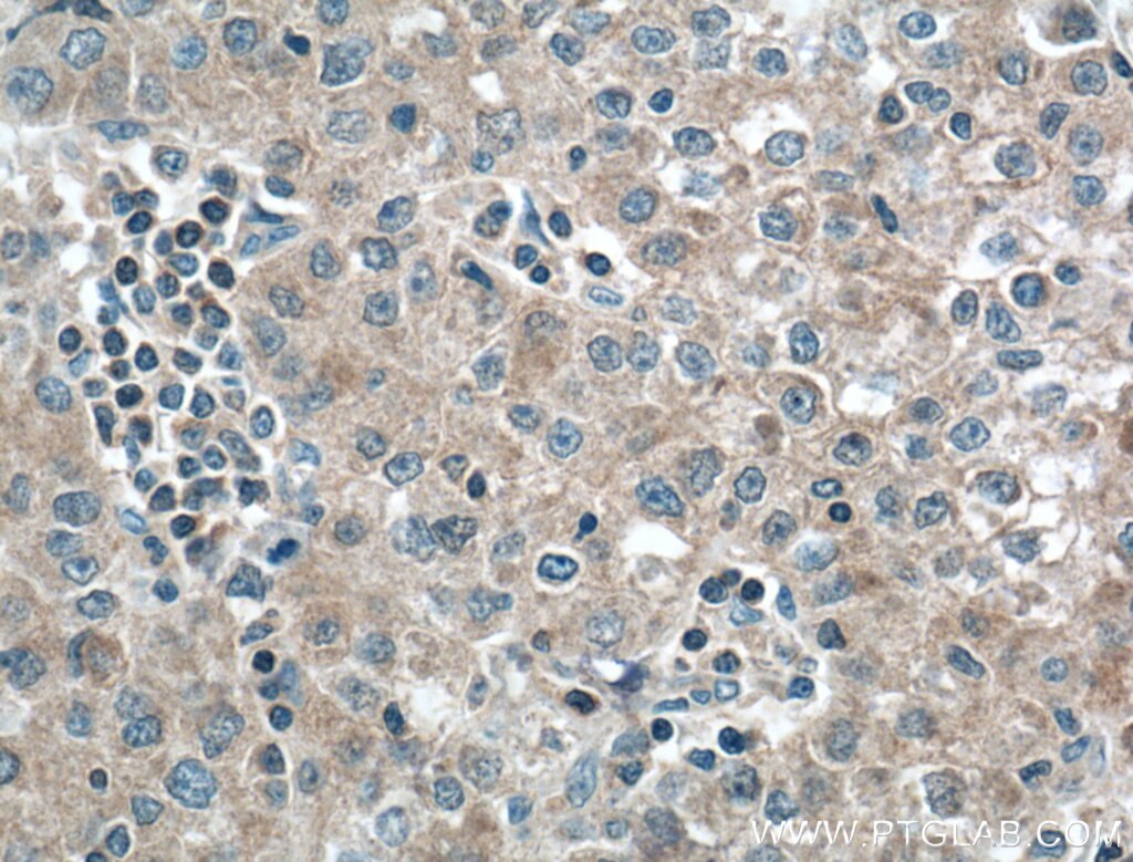 Immunohistochemistry (IHC) staining of human liver cancer tissue using CCM3/PDCD10 Monoclonal antibody (66440-1-Ig)
