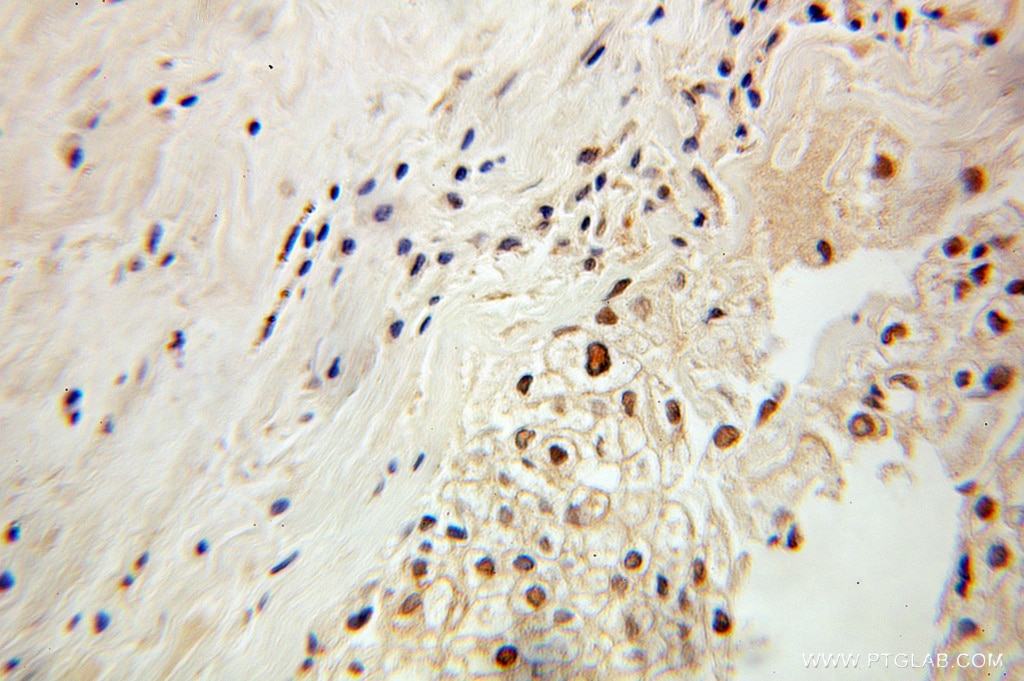 Immunohistochemistry (IHC) staining of human ovary tumor tissue using PDCD2 Polyclonal antibody (10725-1-AP)