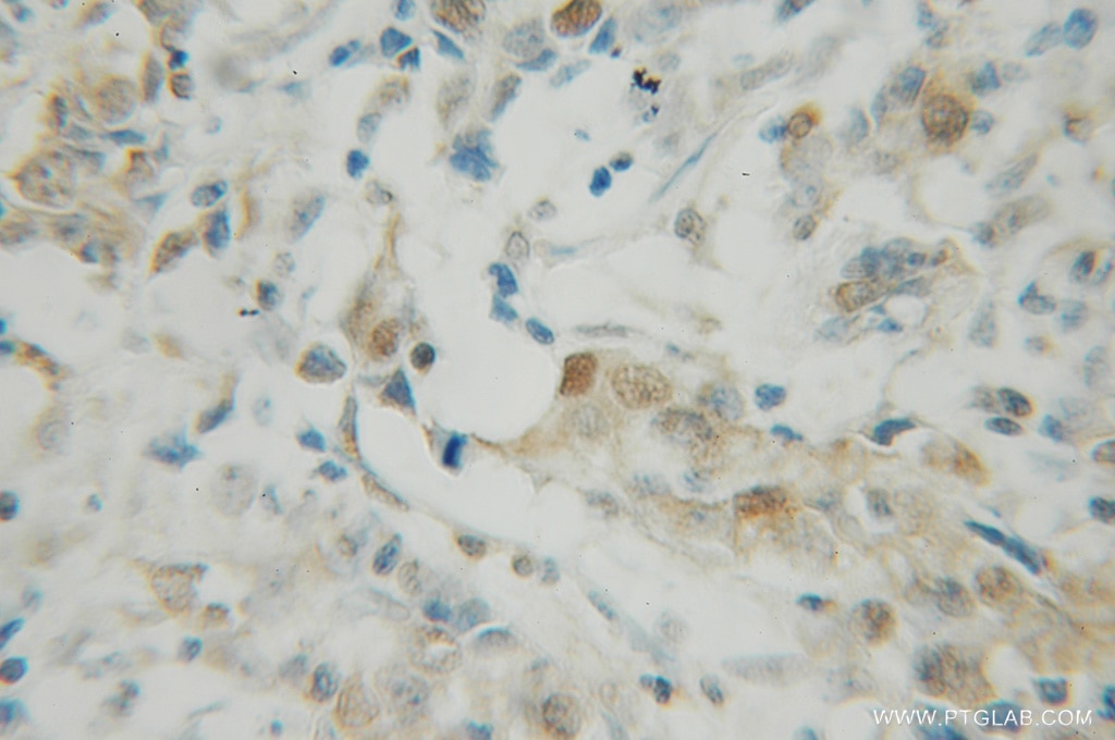 Immunohistochemistry (IHC) staining of human breast cancer tissue using PDCD4 Polyclonal antibody (12587-1-AP)