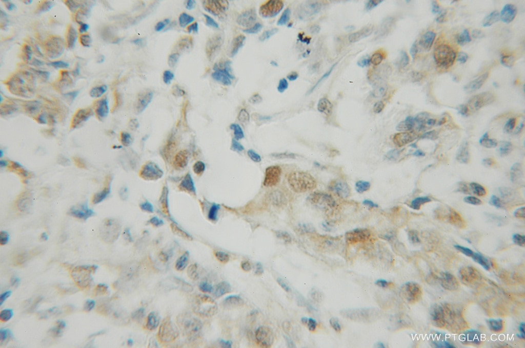 IHC staining of human breast cancer using 12587-1-AP