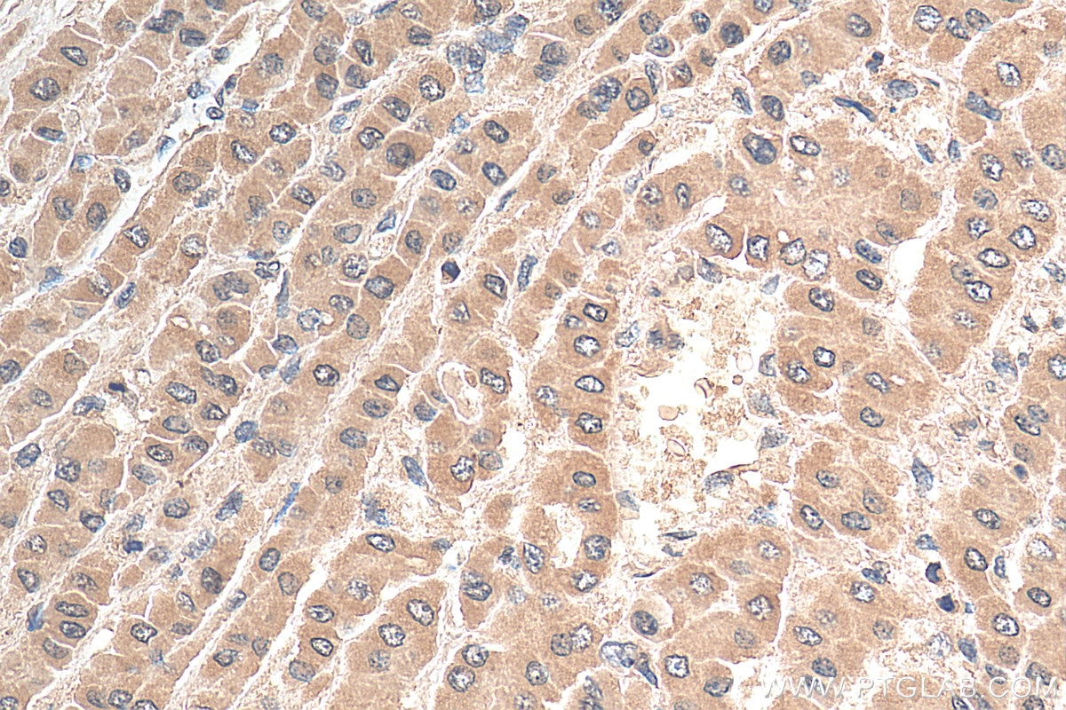 Immunohistochemistry (IHC) staining of human liver cancer tissue using PDCD4 Monoclonal antibody (66100-1-Ig)