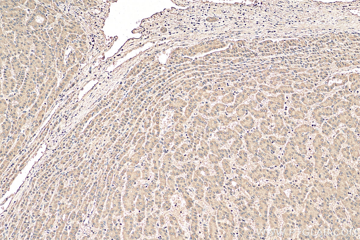 Immunohistochemistry (IHC) staining of human liver cancer tissue using PDCD4 Monoclonal antibody (66100-1-Ig)