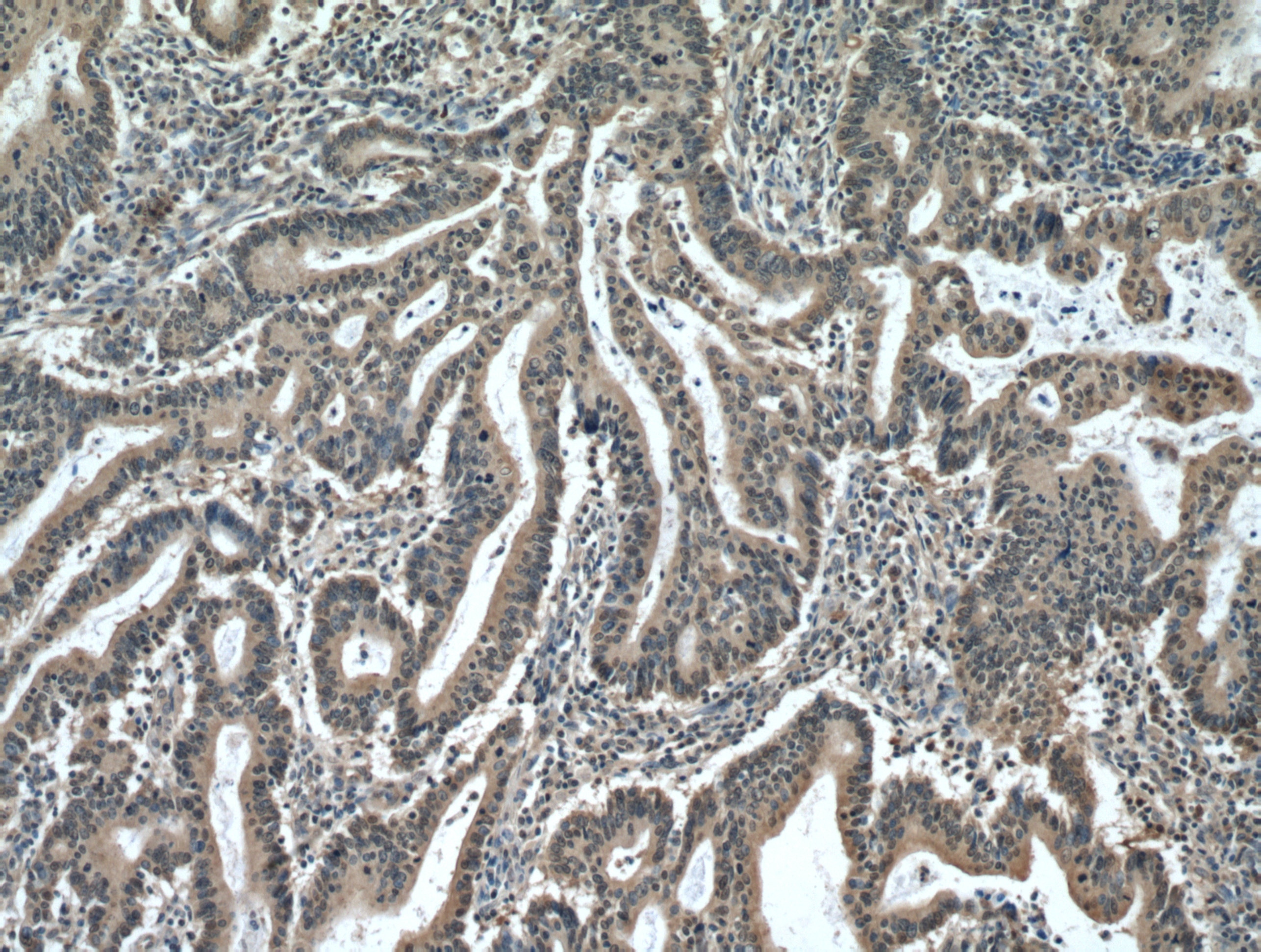 Immunohistochemistry (IHC) staining of human endometrial cancer tissue using PDCD5 Polyclonal antibody (12456-1-AP)