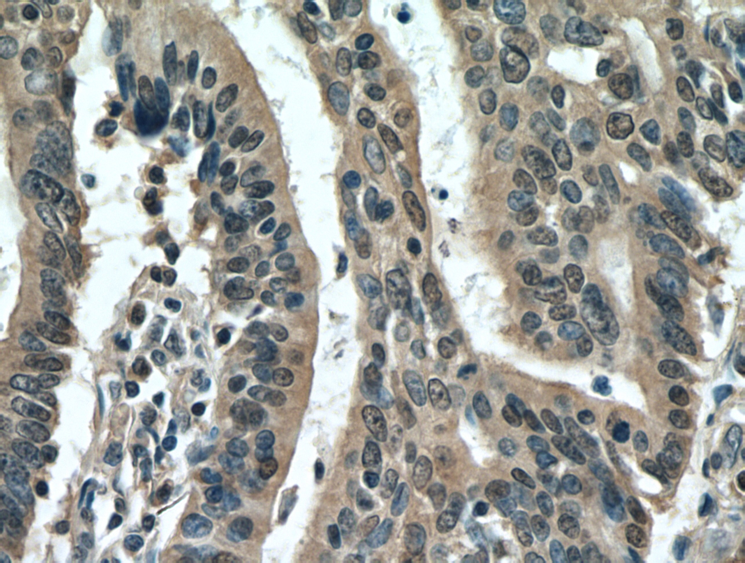 Immunohistochemistry (IHC) staining of human endometrial cancer tissue using PDCD5 Polyclonal antibody (12456-1-AP)