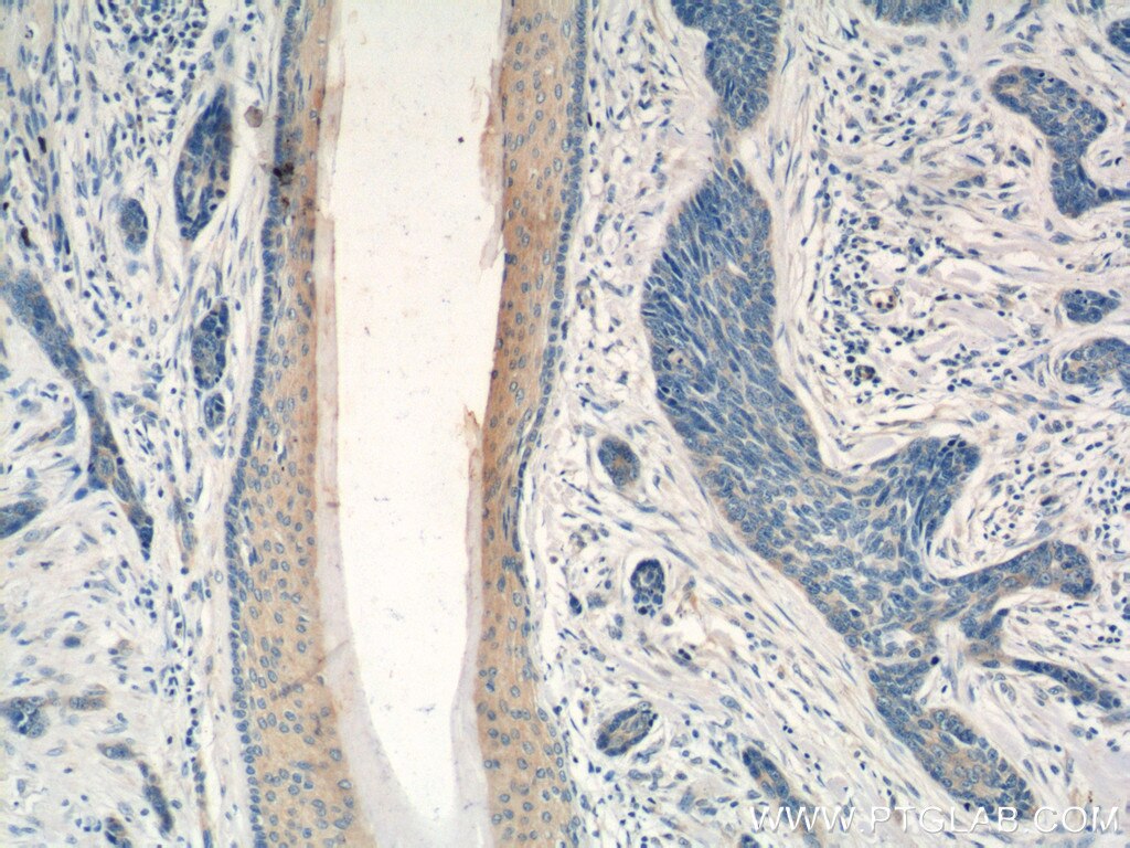 Immunohistochemistry (IHC) staining of human skin cancer tissue using PDCD5 Polyclonal antibody (12456-1-AP)