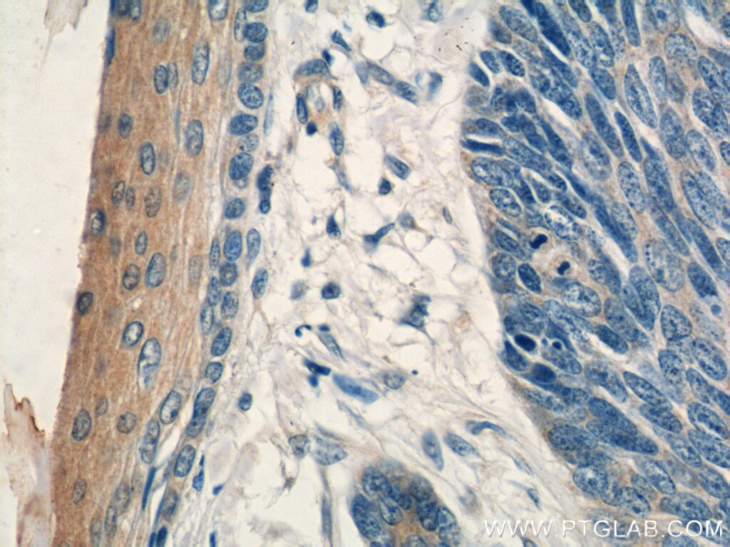 Immunohistochemistry (IHC) staining of human skin cancer tissue using PDCD5 Polyclonal antibody (12456-1-AP)