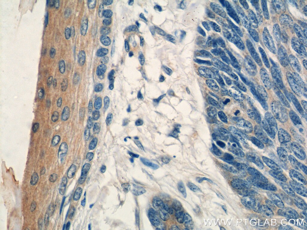 IHC staining of human skin cancer using 12456-1-AP