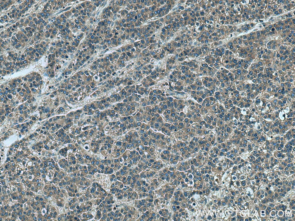 Immunohistochemistry (IHC) staining of human liver cancer tissue using PDCD6 Polyclonal antibody (12303-1-AP)