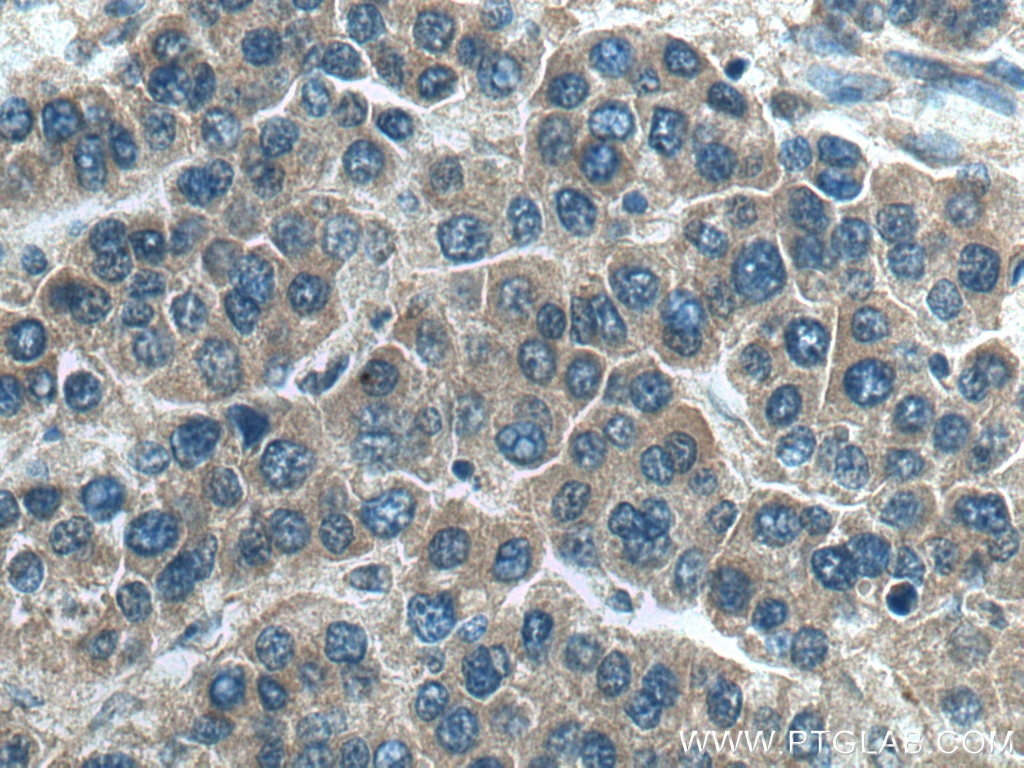 Immunohistochemistry (IHC) staining of human liver cancer tissue using PDCD6 Polyclonal antibody (12303-1-AP)