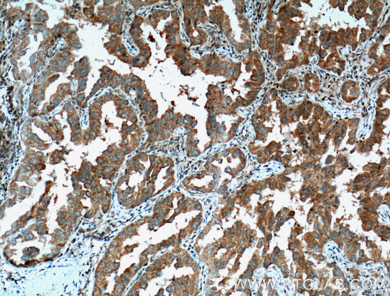 Immunohistochemistry (IHC) staining of human lung cancer tissue using PDCD6 Polyclonal antibody (12303-1-AP)