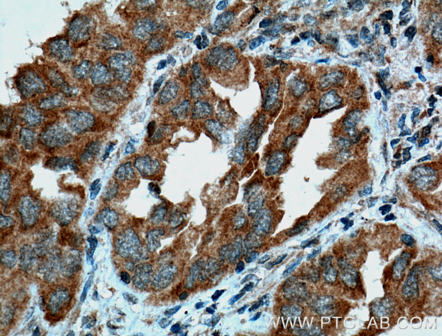 Immunohistochemistry (IHC) staining of human lung cancer tissue using PDCD6 Polyclonal antibody (12303-1-AP)