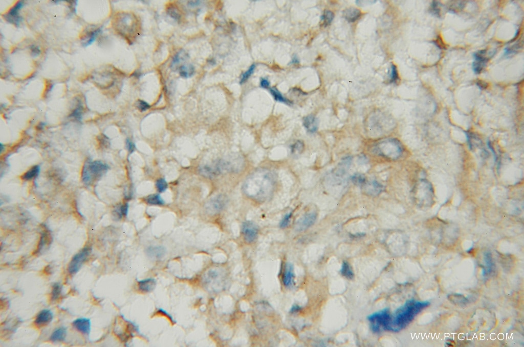 Immunohistochemistry (IHC) staining of human gliomas tissue using PDE1A Polyclonal antibody (12442-2-AP)