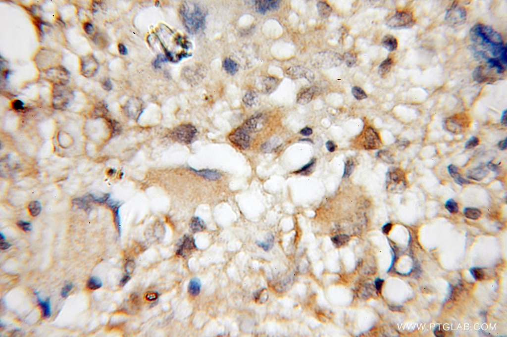 Immunohistochemistry (IHC) staining of human gliomas tissue using PDE1A Polyclonal antibody (12442-2-AP)