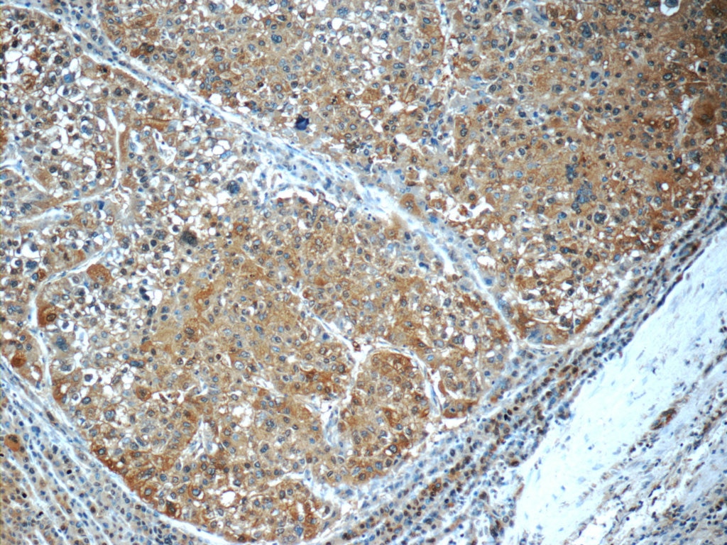 Immunohistochemistry (IHC) staining of human liver cancer tissue using PDE2A Polyclonal antibody (55306-1-AP)
