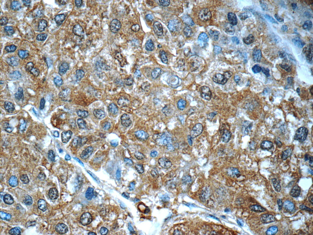 Immunohistochemistry (IHC) staining of human liver cancer tissue using PDE2A Polyclonal antibody (55306-1-AP)