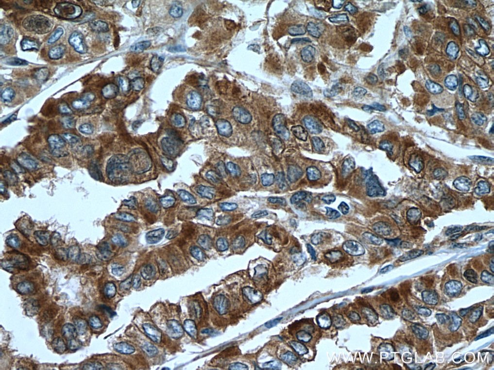 Immunohistochemistry (IHC) staining of human thyroid cancer tissue using PDE5A Polyclonal antibody (22624-1-AP)