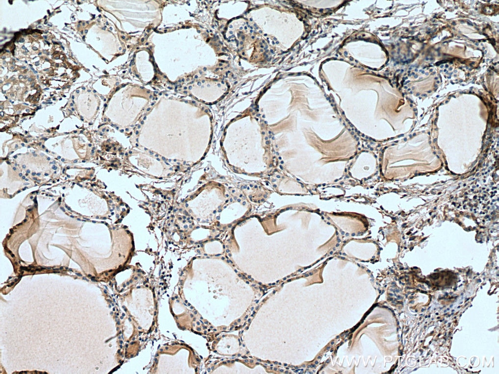Immunohistochemistry (IHC) staining of human thyroid cancer tissue using PDE5A Polyclonal antibody (22624-1-AP)