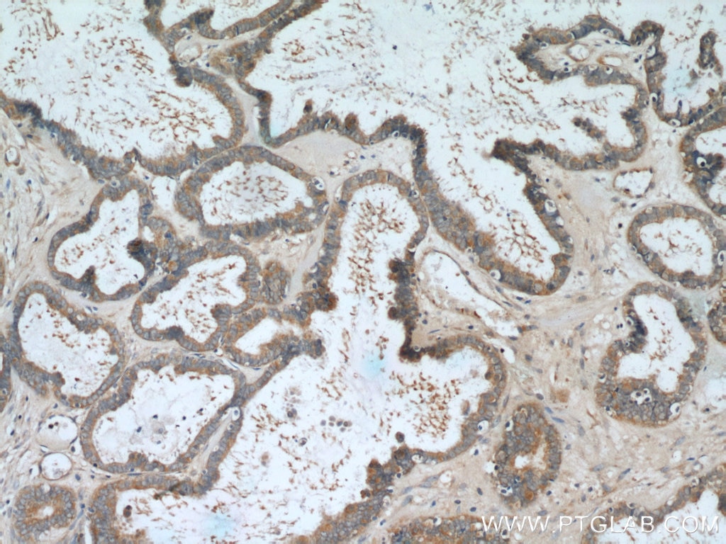 Immunohistochemistry (IHC) staining of human ovary tumor tissue using PDE5A Polyclonal antibody (22624-1-AP)