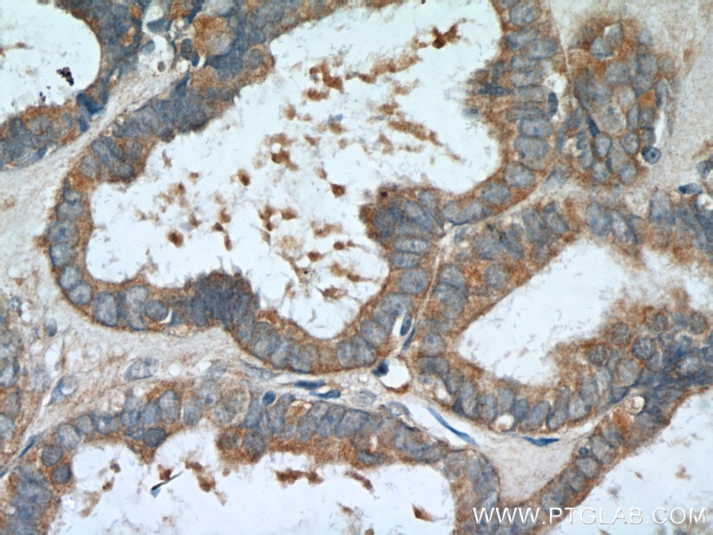 Immunohistochemistry (IHC) staining of human ovary tumor tissue using PDE5A Polyclonal antibody (22624-1-AP)