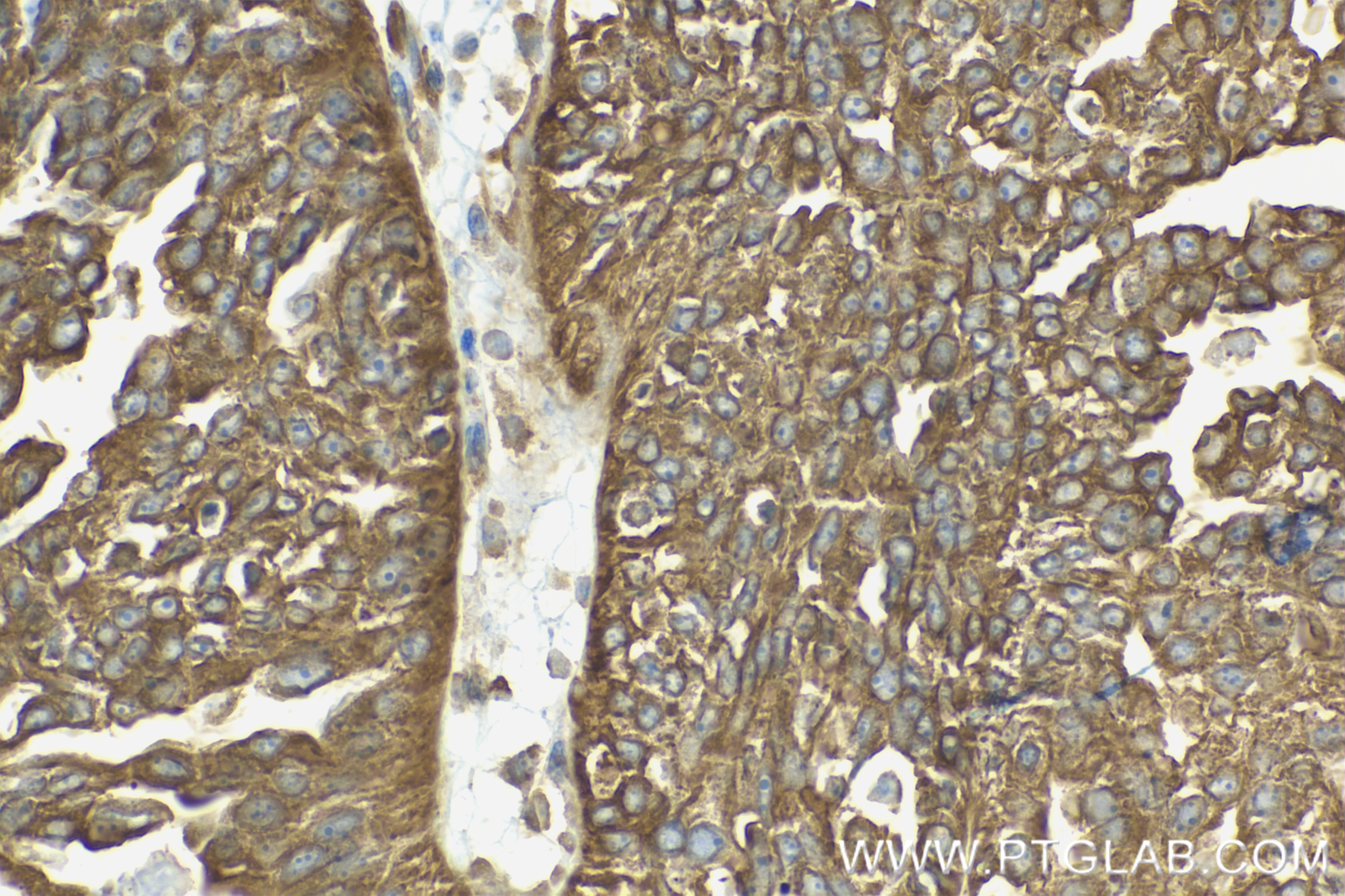 Immunohistochemistry (IHC) staining of human ovary cancer tissue using PDE5A Recombinant monoclonal antibody (85030-1-RR)