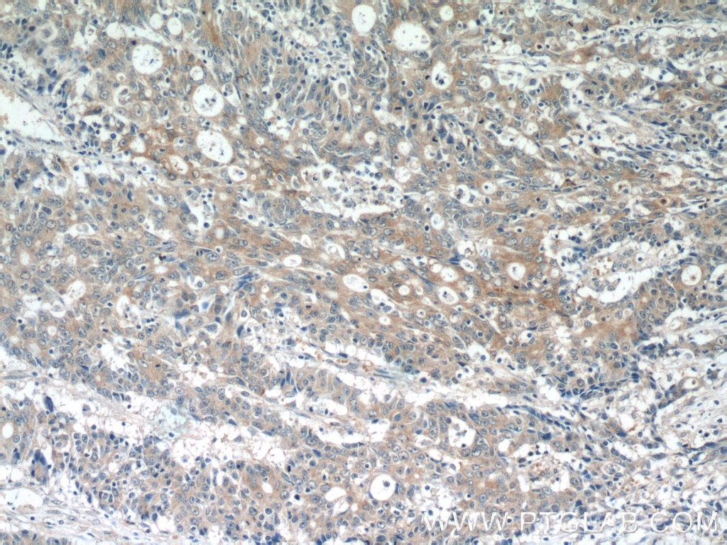 Immunohistochemistry (IHC) staining of human colon cancer tissue using PDE6A Polyclonal antibody (21200-1-AP)