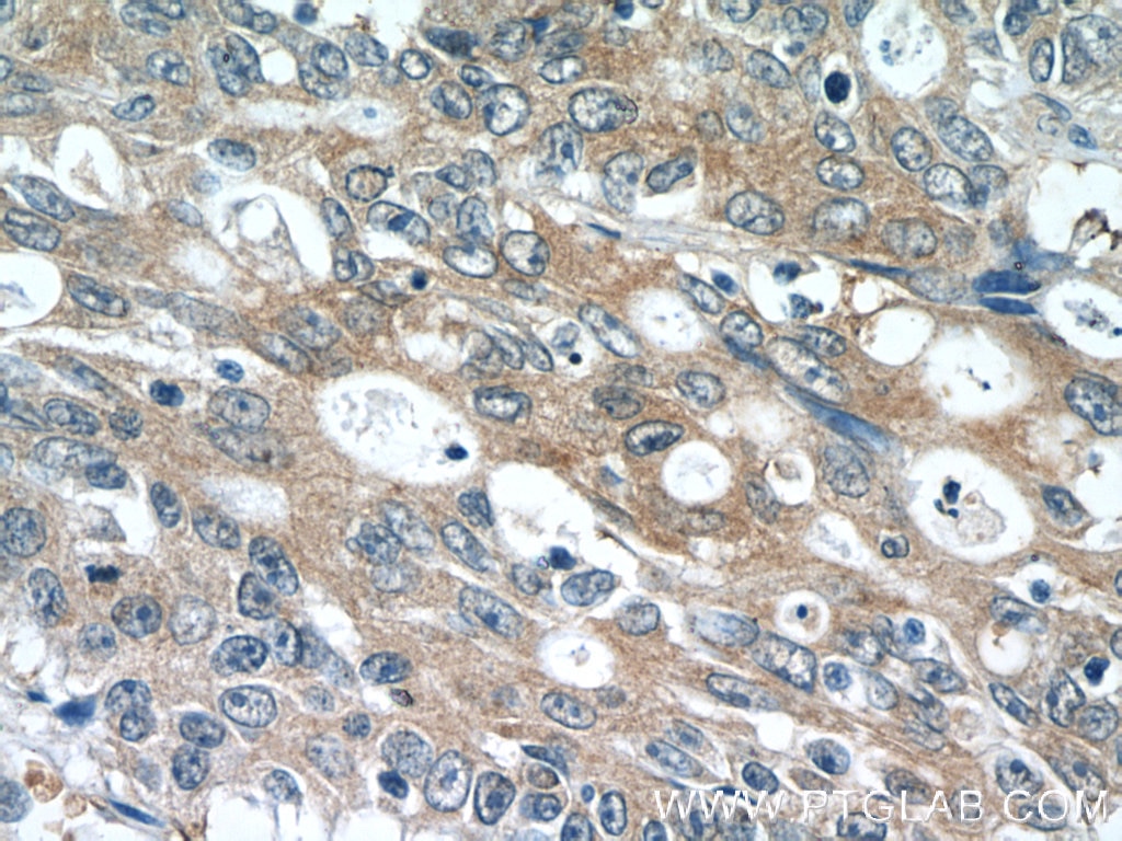 Immunohistochemistry (IHC) staining of human colon cancer tissue using PDE6A Polyclonal antibody (21200-1-AP)