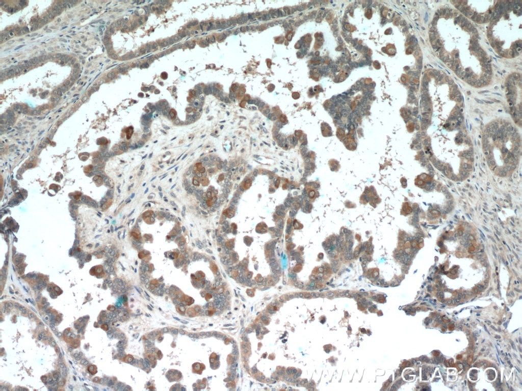 Immunohistochemistry (IHC) staining of human ovary tumor tissue using PDE6A Polyclonal antibody (21200-1-AP)