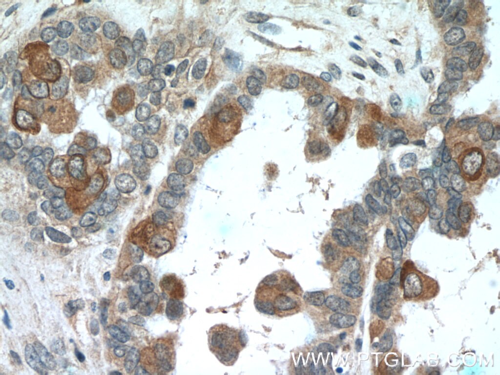 Immunohistochemistry (IHC) staining of human ovary tumor tissue using PDE6A Polyclonal antibody (21200-1-AP)