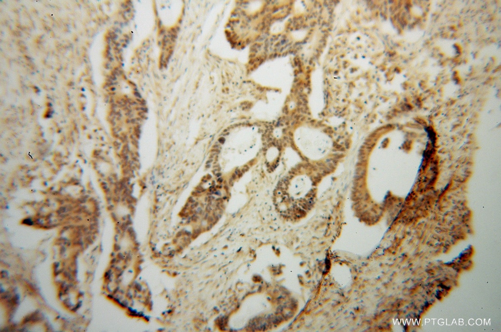 Immunohistochemistry (IHC) staining of human colon cancer tissue using PDE8A Polyclonal antibody (13956-1-AP)