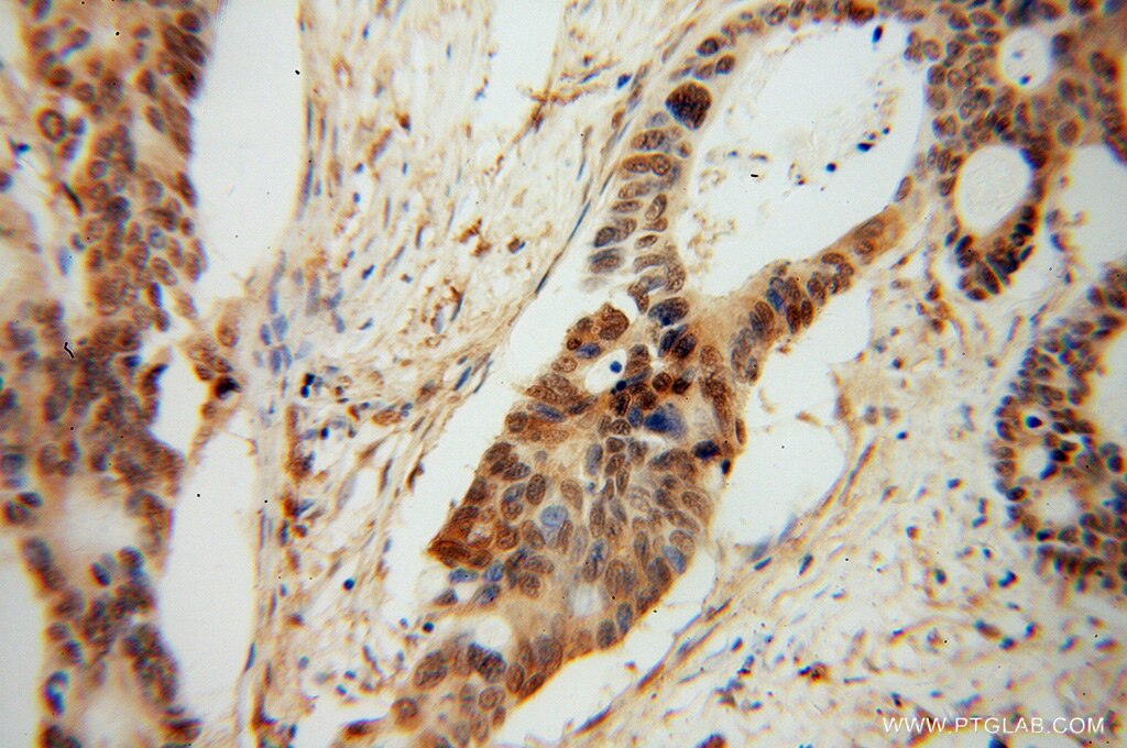 Immunohistochemistry (IHC) staining of human colon cancer tissue using PDE8A Polyclonal antibody (13956-1-AP)