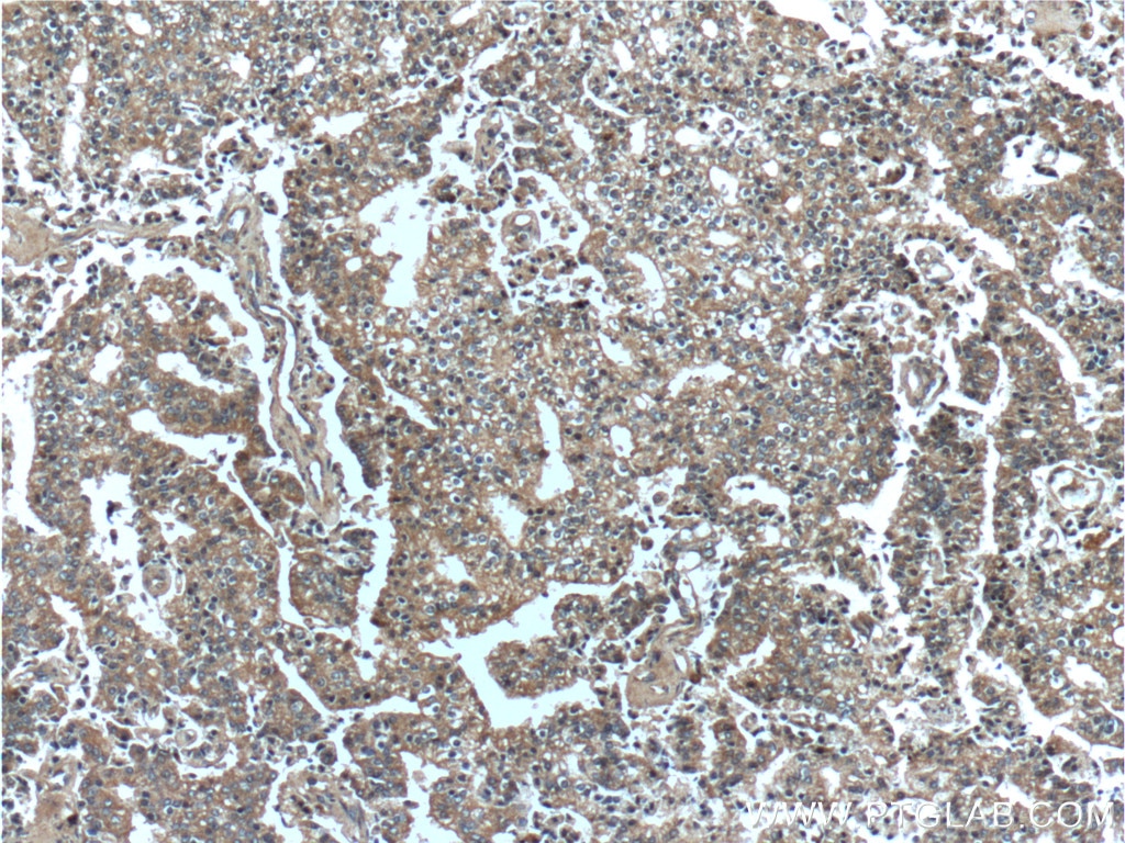 Immunohistochemistry (IHC) staining of human prostate cancer tissue using PDE9A Polyclonal antibody (12648-1-AP)