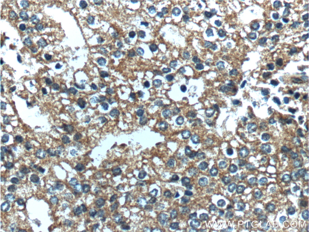 Immunohistochemistry (IHC) staining of human prostate cancer tissue using PDE9A Polyclonal antibody (12648-1-AP)