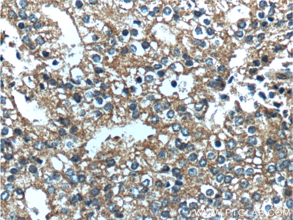 IHC staining of human prostate cancer using 12648-1-AP